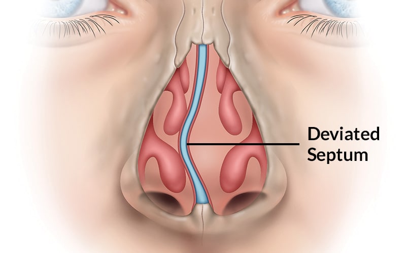 Deviated Nasal Septum RMI