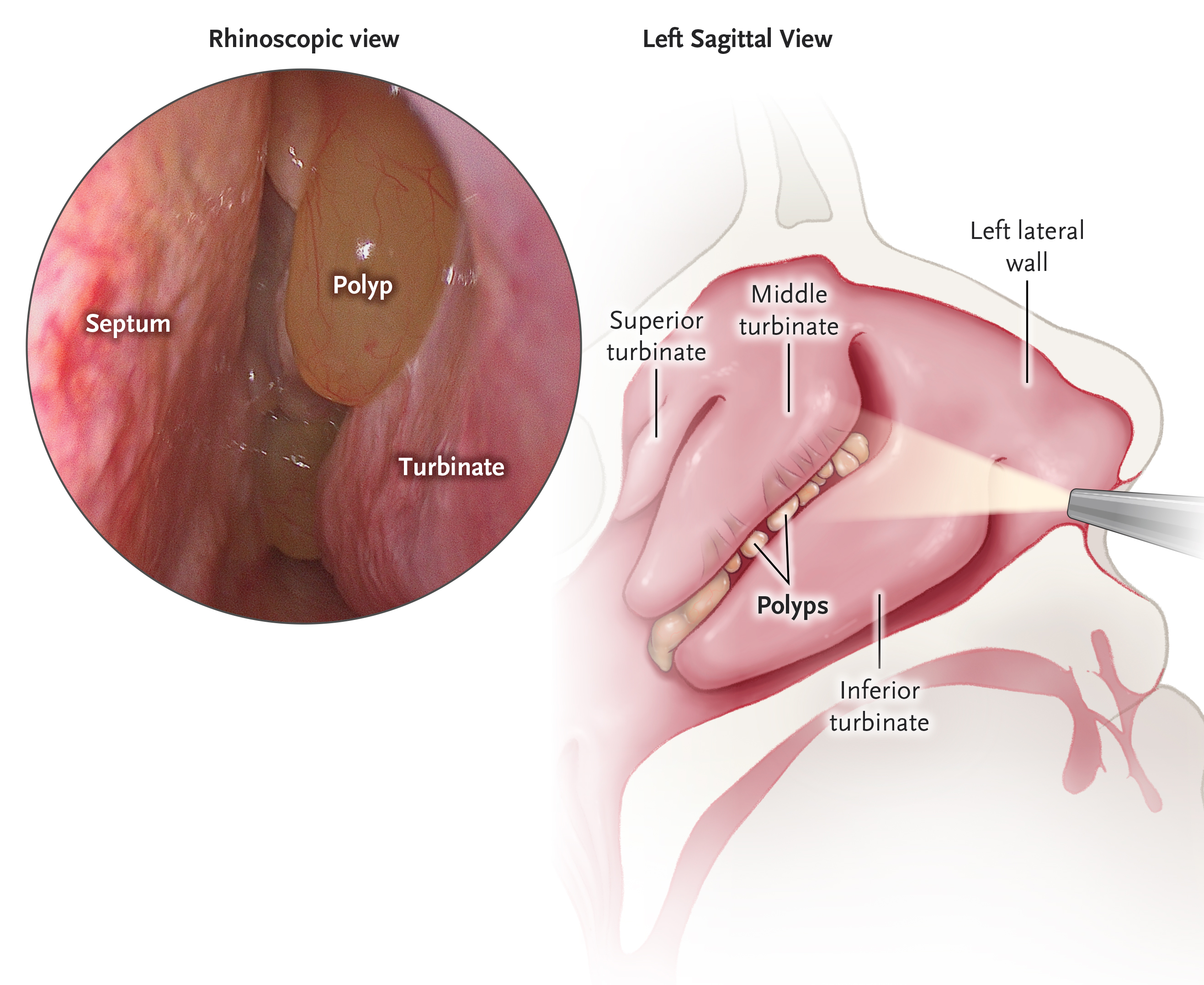 Nasal polyp deals