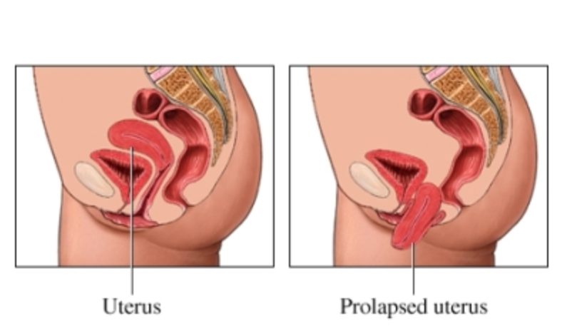 How to Treat Bladder Prolapse