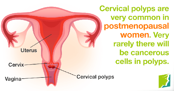Postmenopausal Bleeding Common in Women With Endometrial Cancer