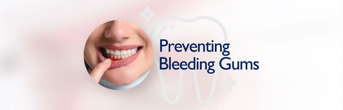 How to Prevent Bleeding Gums