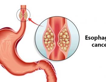 Oesophageal Cancer
