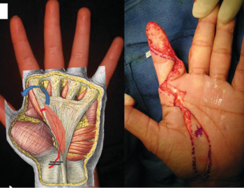 Hand injuries and reconstruction
