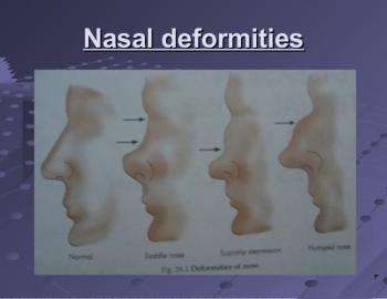 Nasal Deformities 
