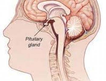 Pituitary adenoma 