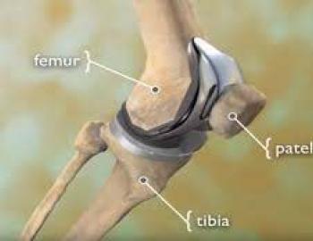 Total joint replacement 