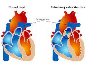 Pulmonary Valve Stenosis