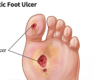 Diabetic Foot Ulcer 