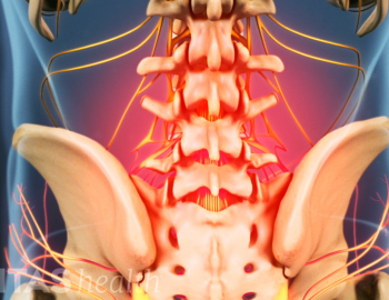 Backache and Degeneration Spine Disease