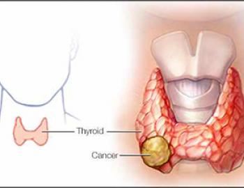 Thyroid Cancer 