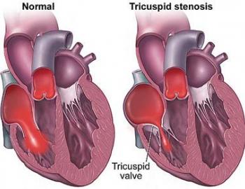 Tricuspid Stenosis