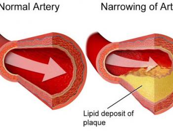 Lipid Disorders