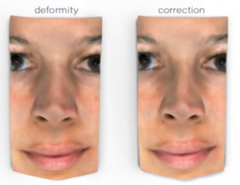 Nasal Deformity