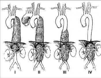 Thoraco-Abdominal Aortic Aneurysms & Dissections