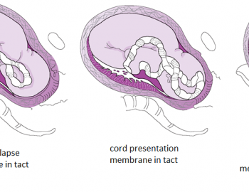 Umbilical Cord Compression: Causes and Signs