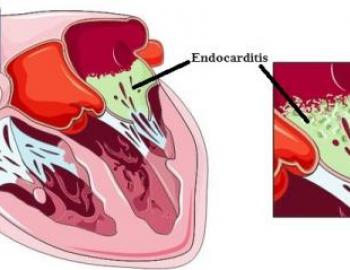 Infective Endocarditis (Valvular Vegetation)
