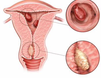 Uterine Polyps