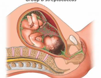 Group B Streptococcus and Pregnancy
