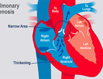 Pulmonary Stenosis