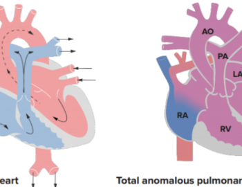 Total Anomalous Pulmonary Venous Drainage