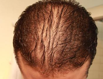 Diffuse hair loss