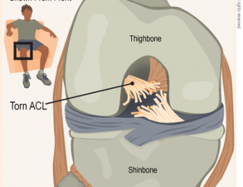 ligament tear