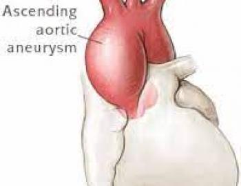 aortic aneurism