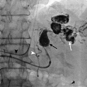 Gastric Sclerotherapy