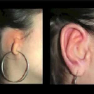 Ear Reconstruction-RMI
