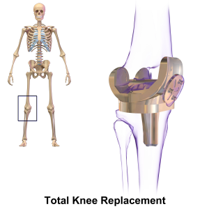 Revision & Reconstruction of Failed/Loose Joint Replacement Surgery-RMI