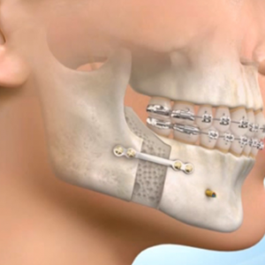 Orthognathic Surgery