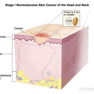 Head & Neck Skin Malignancy & Vascular Malformations-RMI