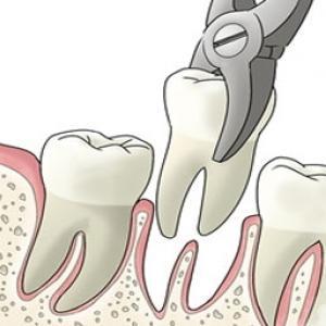 Extractions-RCD-dental-Clinics