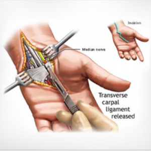 Reconstructive Hand Surgery-RMI