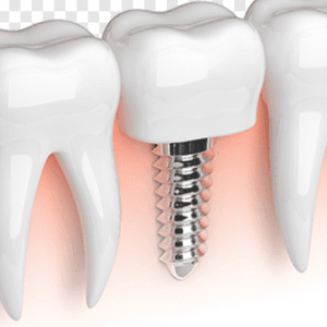 Dentoalveolar Surgery and Implantology