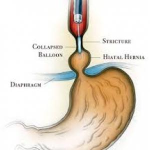 esophageal dilatation