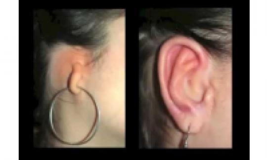 Ears reconstruction & aesthetics