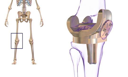 Revision & Reconstruction of Failed/Loose Joint Replacement Surgery