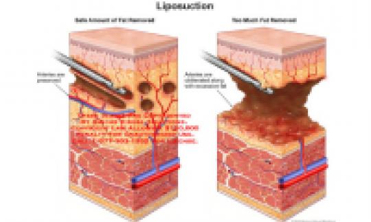 Liposuction