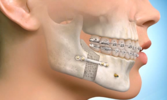 Orthognathic Surgery