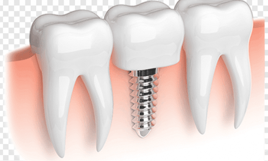 Dentoalveolar Surgery and Implantology