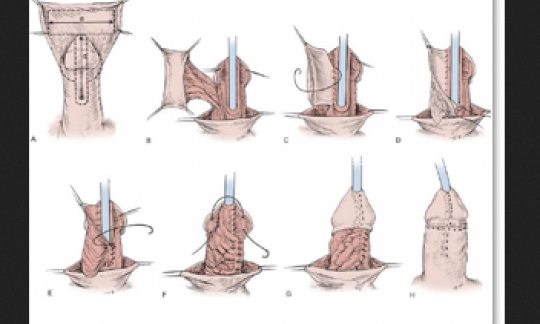 Urethral Reconstruction Surgeries