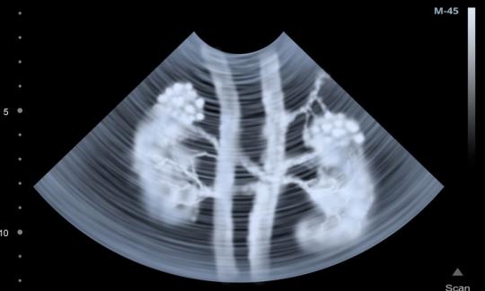 Renal/Urology /Dialysis Access Procedures