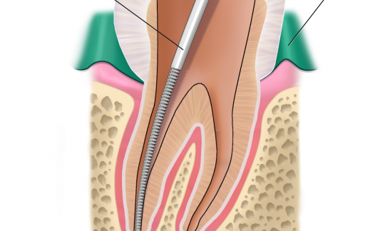 Root Canal Treatment