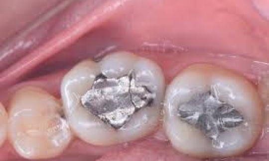 Amalgam Fillings of Posterior Teeth