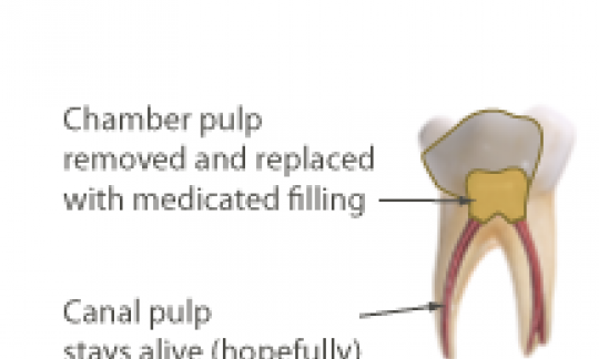 Pulpotomies of Permanent Teeth